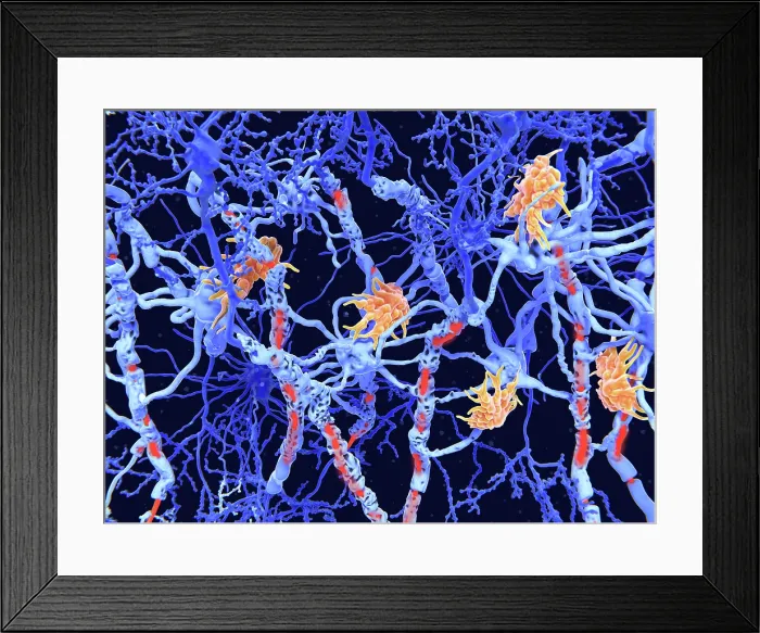 Framed Print : Multiple sclerosis (MS): microglia cells damage the myelin sheath of neuron axons Framed Print : Multiple sclerosis (MS): microglia cells damage the myelin sheath of neuron axons