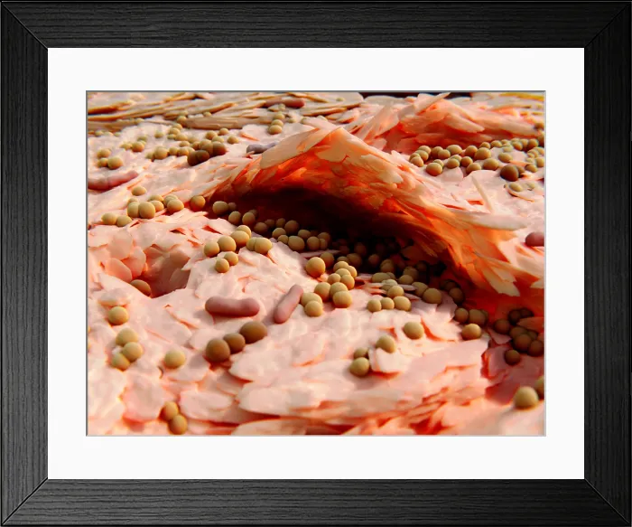 Framed Print : Staphylococcus aureus bacteria on the cracked skin of a neurodermatitis patient Framed Print : Staphylococcus aureus bacteria on the cracked skin of a neurodermatitis patient