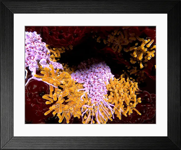 Framed Print : Macrophages engulfing tuberculosis bacillus in the lungs