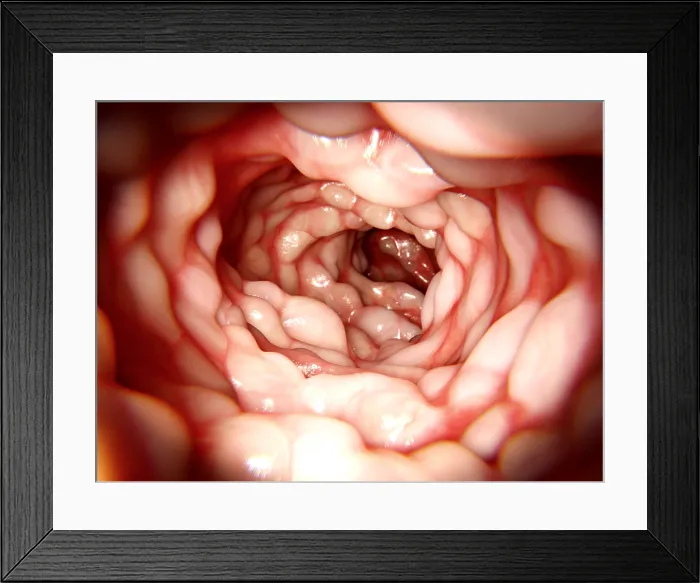Framed Print : Intestine affected by Crohn's disease Framed Print : Intestine affected by Crohn's disease