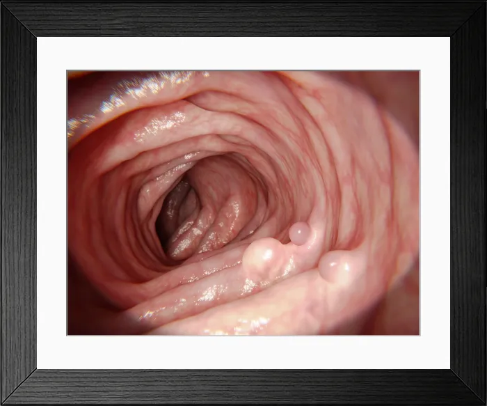 Framed Print : Polyps in human intestine Framed Print : Polyps in human intestine