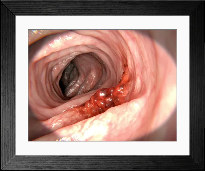 Framed Print : Colorectal cancer Framed Print : Colorectal cancer