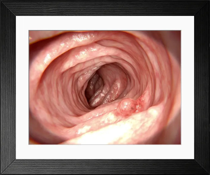 Framed Print : Adenomatous polyp Framed Print : Adenomatous polyp