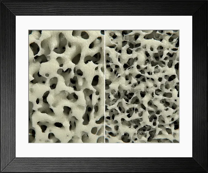 Framed Print : Osteoporosis, healthy (leftI) and osteoporotic (right) bone tissue, Illustration Framed Print : Osteoporosis, healthy (leftI) and osteoporotic (right) bone tissue, Illustration