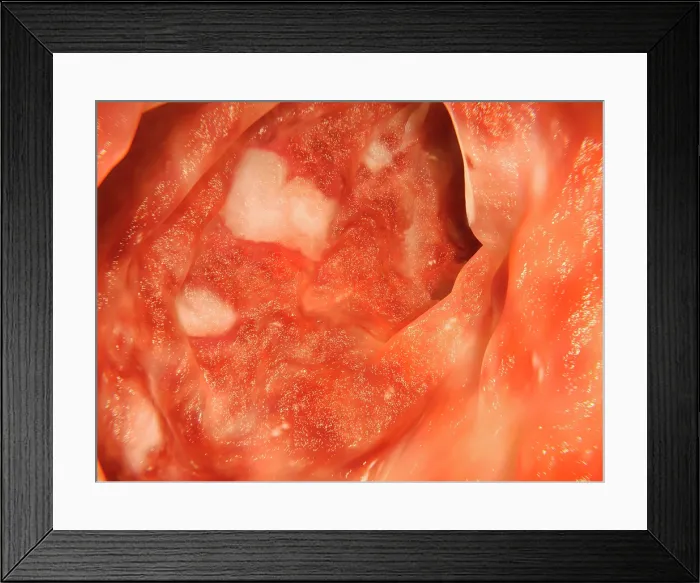 Framed Print : Ulcerative colitis, artwork Framed Print : Ulcerative colitis, artwork