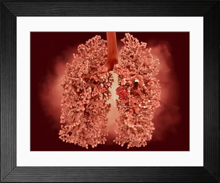 Framed Print : Lung cancer, artwork