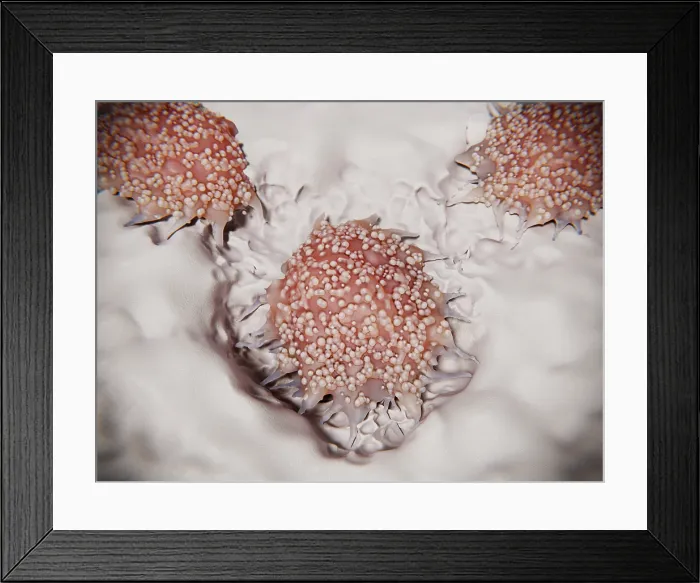 Framed Print : Osteoporosis: osteoclasts degrade and reabsorb bone tissue Framed Print : Osteoporosis: osteoclasts degrade and reabsorb bone tissue