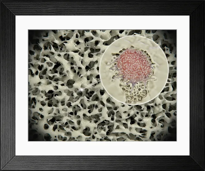 Framed Print : Osteoporosis: osteoporotic bone tissue. Osteoclast degrades bone tissue Framed Print : Osteoporosis: osteoporotic bone tissue. Osteoclast degrades bone tissue