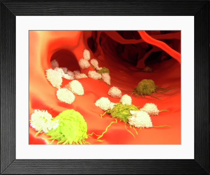 Framed Print : T-lymphocytes and cancer cells, artwork