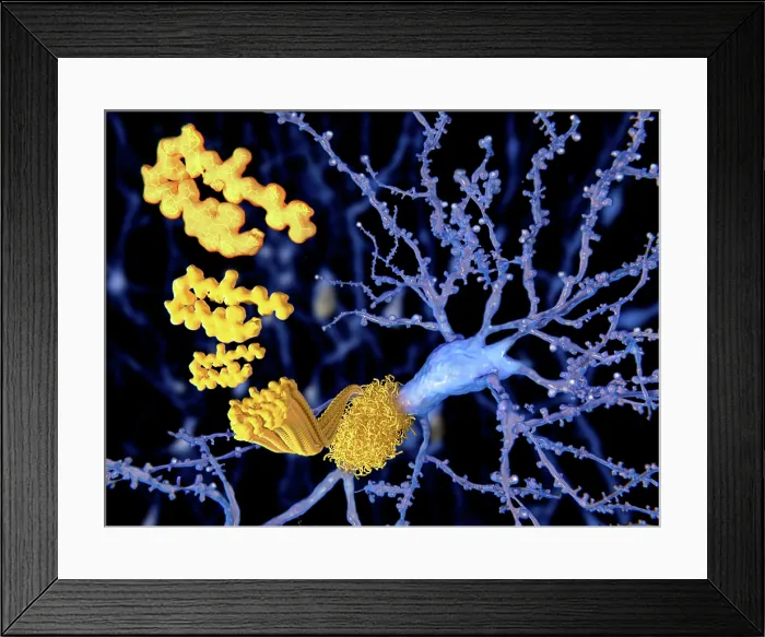 Framed Print : Alzheimer disease, the beta-amyloid peptid Framed Print : Alzheimer disease, the beta-amyloid peptid