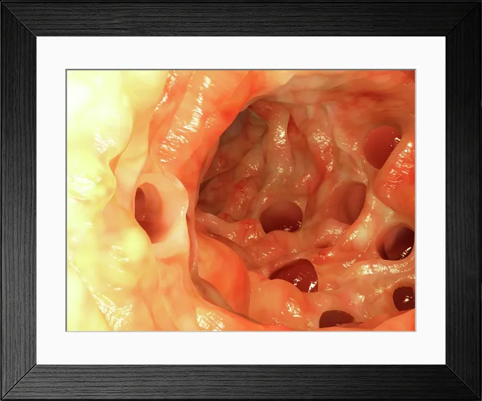 Framed Print : Diverticula in colon, artwork Framed Print : Diverticula in colon, artwork