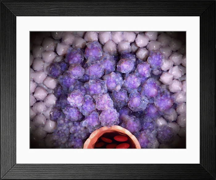 Framed Print : Tumor growing around a blood vessel