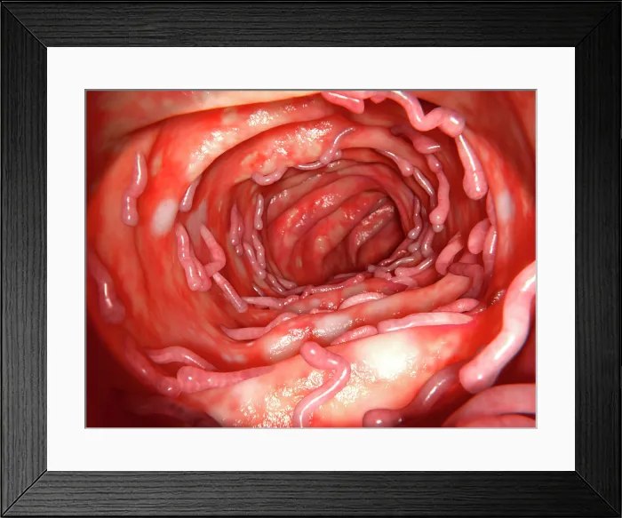 Framed Print : Ulcerative colitis and pseudopolyps, illustration Framed Print : Ulcerative colitis and pseudopolyps, illustration