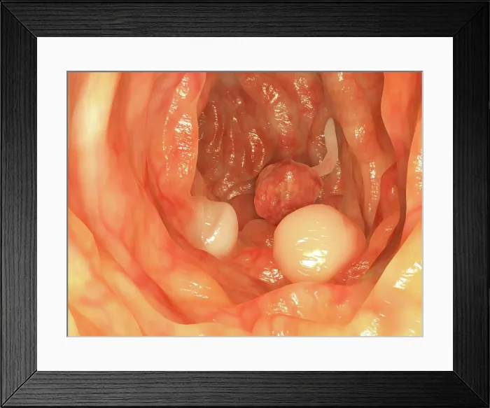 Framed Print : Polyps in colon, artwork