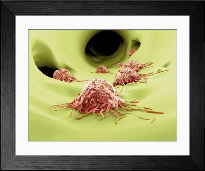 Framed Print : Cancer cells, artwork
