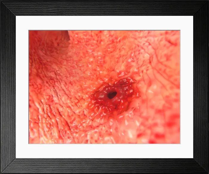 Framed Print : Peptic ulcer, artwork Framed Print : Peptic ulcer, artwork
