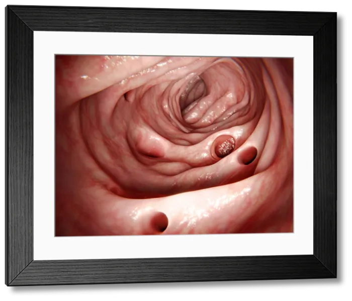 Framed Print : Diverticulosis Framed Print : Diverticulosis