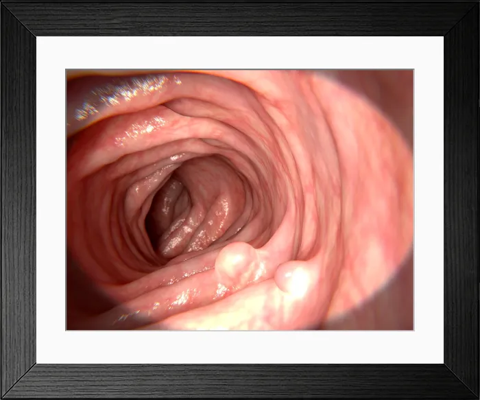 Framed Print : Polyps in the intestine Framed Print : Polyps in the intestine