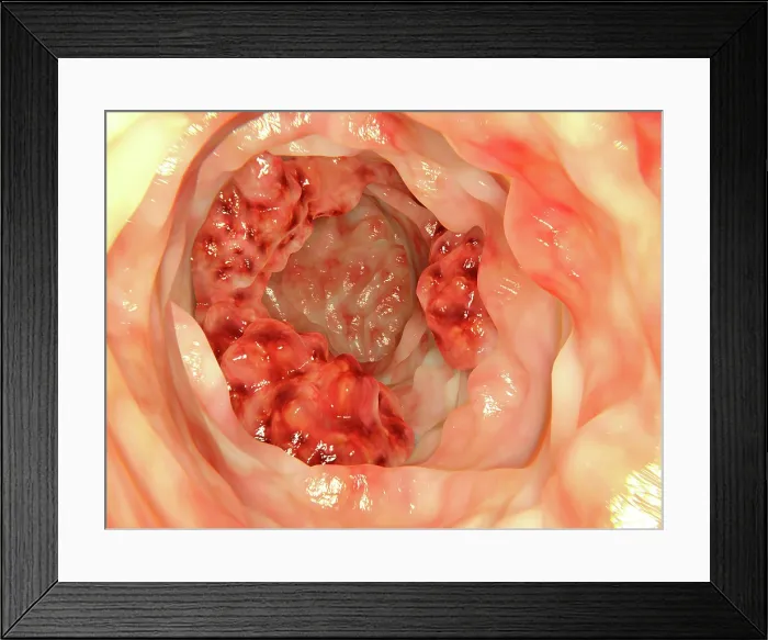 Framed Print : Colon cancer, artwork Framed Print : Colon cancer, artwork