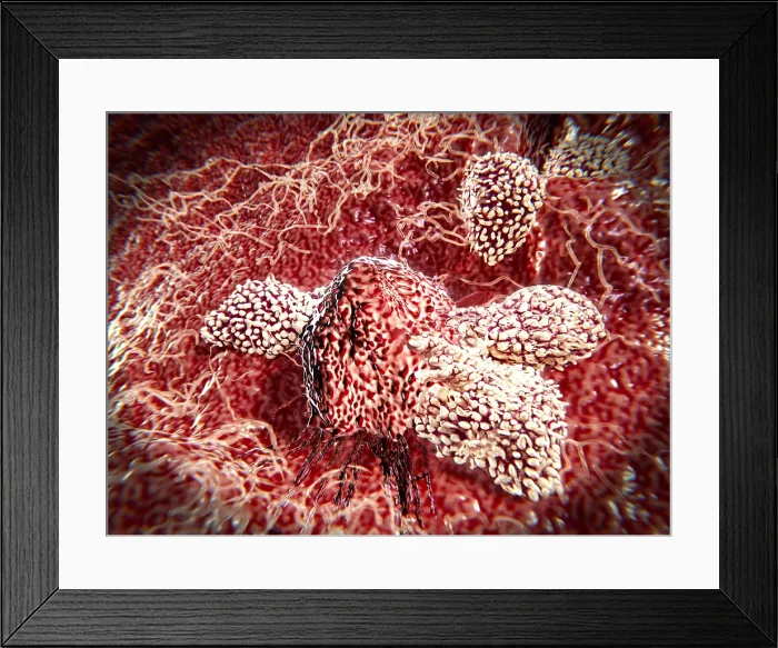 Framed Print : Cancer cell attacked by lymphocytes Framed Print : Cancer cell attacked by lymphocytes