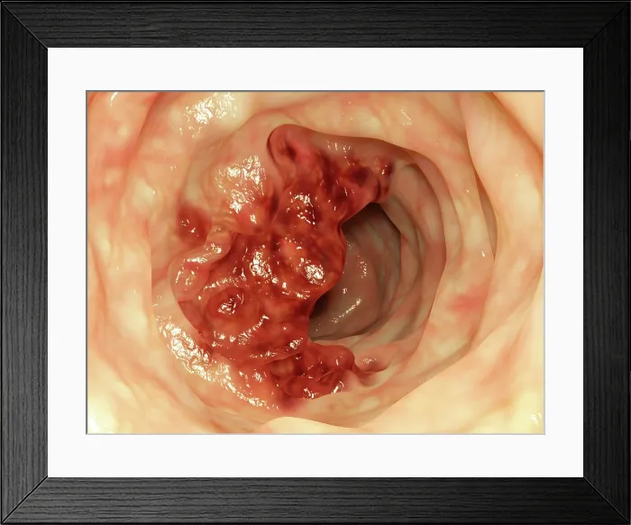 Framed Print : Intestinal tumor, artwork Framed Print : Intestinal tumor, artwork