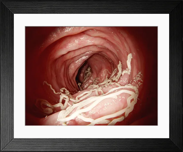 Framed Print : Large roundworm in human intestines