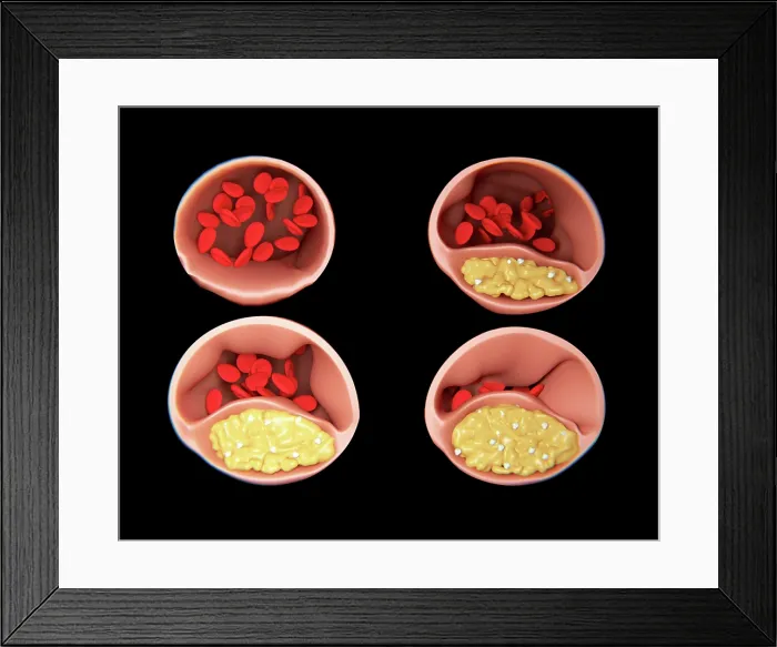Framed Print : Atherosclerosis, artwork Framed Print : Atherosclerosis, artwork