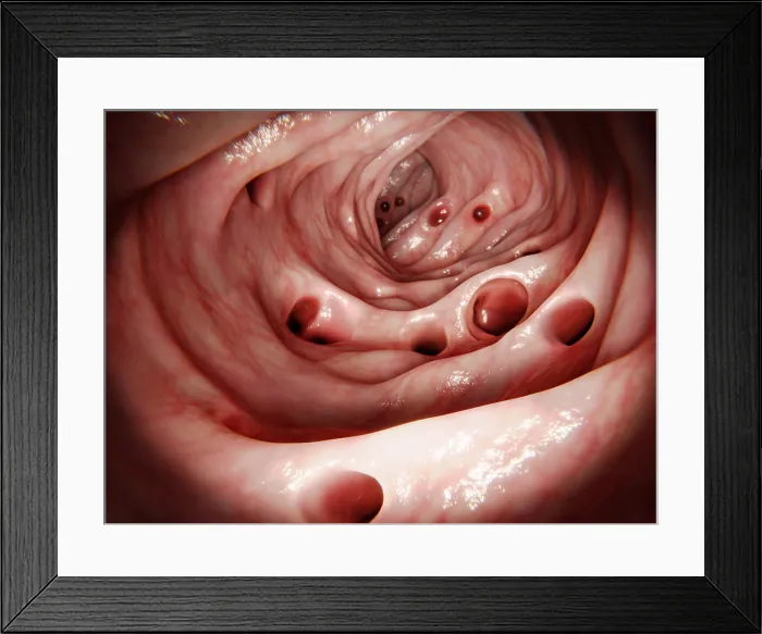 Framed Print : Massive diverticulosis in human intestine, computer artwork
