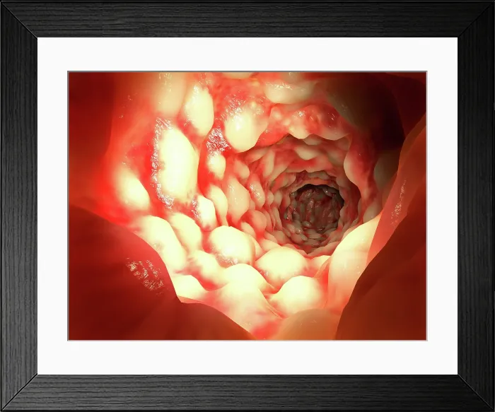 Framed Print : Crohn's disease, artwork