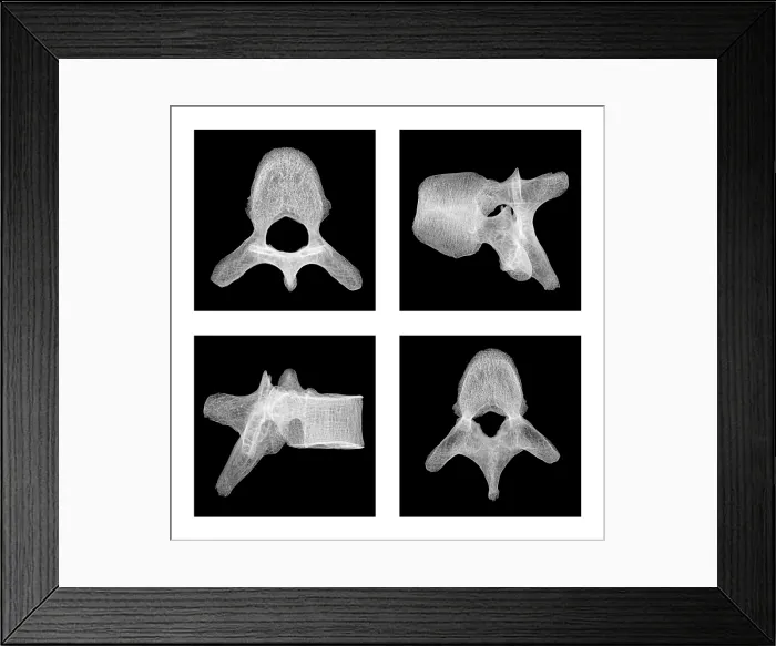 Framed Print : Human Vertebra T5, X-ray Framed Print : Human Vertebra T5, X-ray