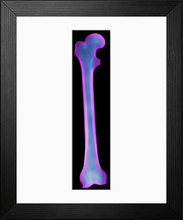 Framed Print : X-ray of Human Femur Framed Print : X-ray of Human Femur