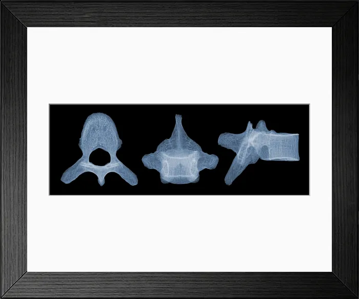 Framed Print : Human Vertebra T5, X-ray Framed Print : Human Vertebra T5, X-ray