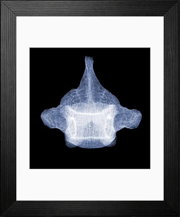 Framed Print : Human Vertebra T5, X-ray Framed Print : Human Vertebra T5, X-ray