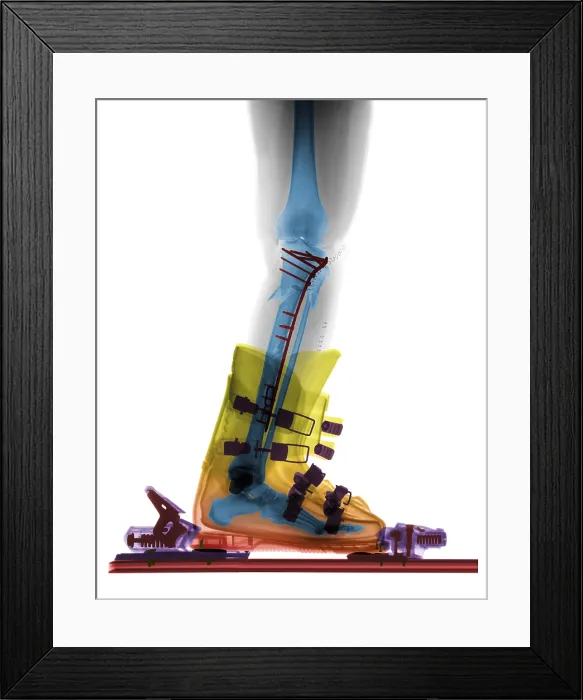 Framed Print : X-ray of Broken Bones in Ski boot Framed Print : X-ray of Broken Bones in Ski boot