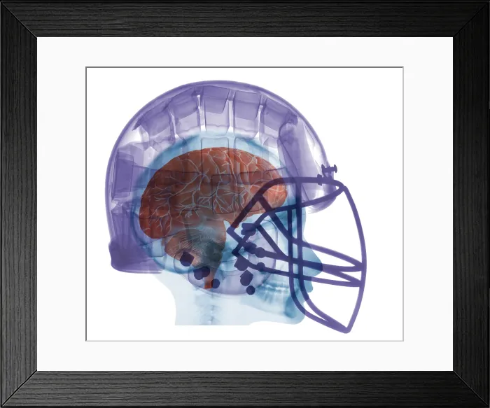 Framed Print : X-ray of Head in Football Helmet Framed Print : X-ray of Head in Football Helmet