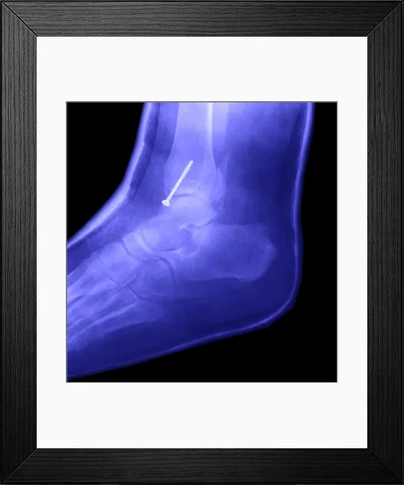 Framed Print : Broken Ankle