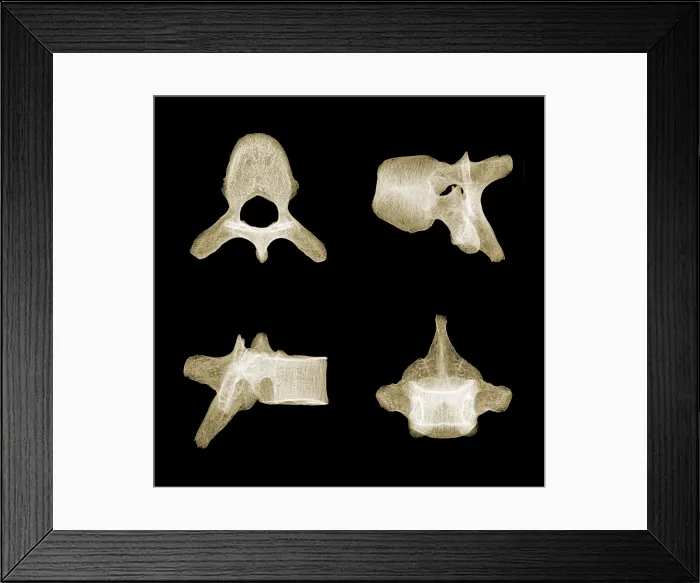 Framed Print : Human Vertebra T5, X-ray Framed Print : Human Vertebra T5, X-ray