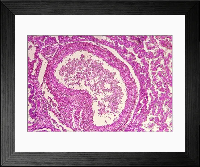 Framed Print : The effects of HIV on human lung tissue under a microscope