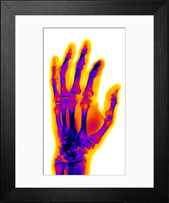 Framed Print : Finger Fracture Framed Print : Finger Fracture