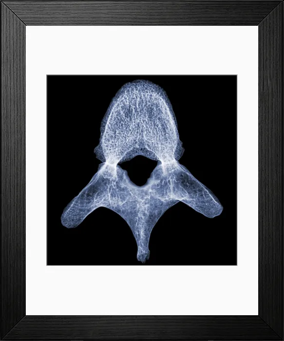 Framed Print : Human Vertebra T5, X-ray Framed Print : Human Vertebra T5, X-ray