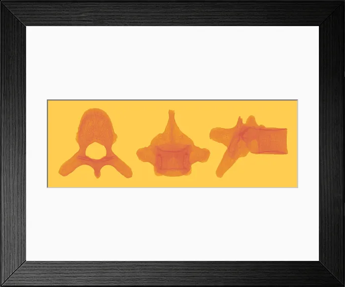 Framed Print : Human Vertebra T5, X-ray Framed Print : Human Vertebra T5, X-ray