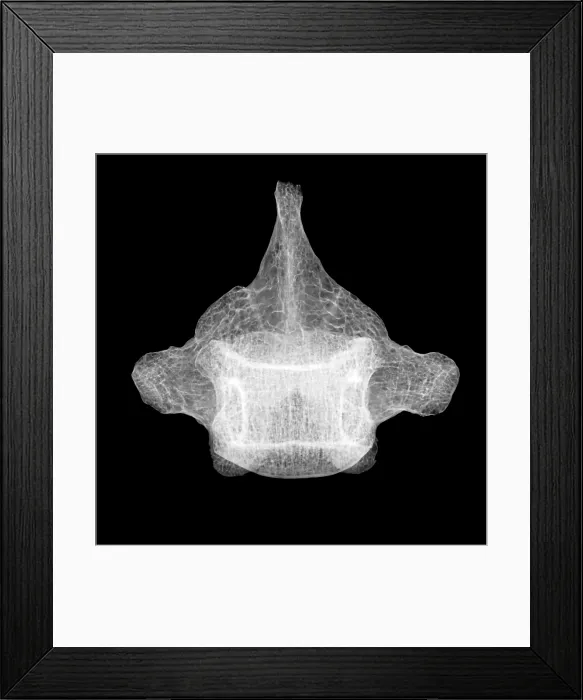 Framed Print : Human Vertebra T5, X-ray Framed Print : Human Vertebra T5, X-ray