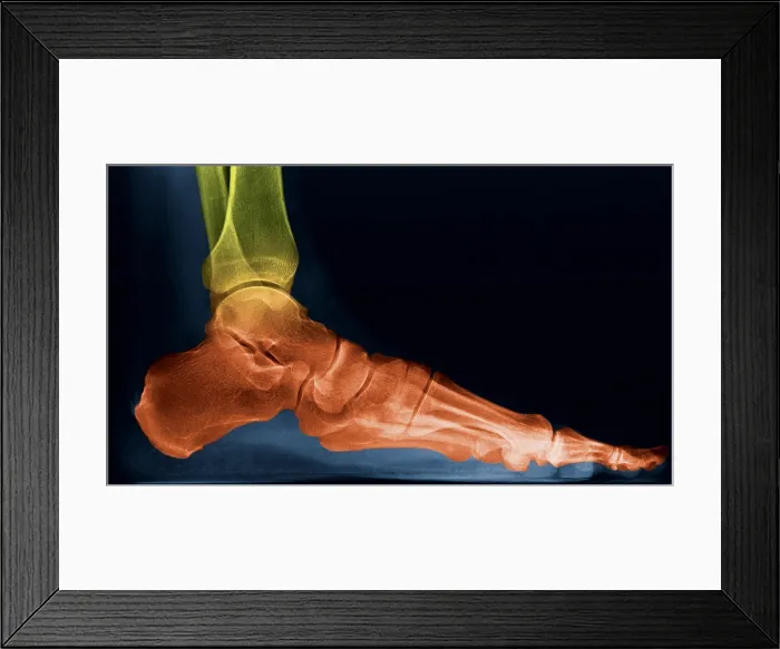 Framed Print : Foot X-Ray