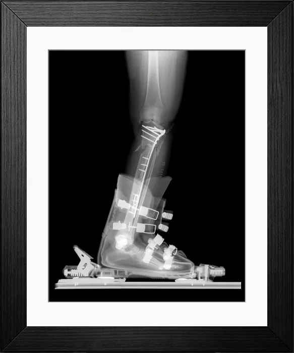 Framed Print : X-ray of Broken Bones in Ski boot