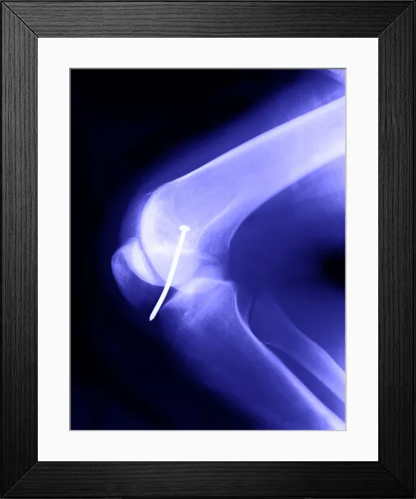 Framed Print : Knee X-Ray Framed Print : Knee X-Ray