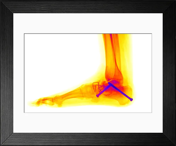 Framed Print : Ankle Fracture Framed Print : Ankle Fracture