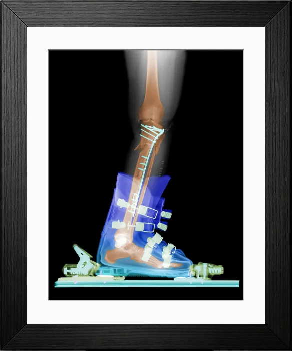 Framed Print : X-ray of Broken Bones in Ski boot Framed Print : X-ray of Broken Bones in Ski boot