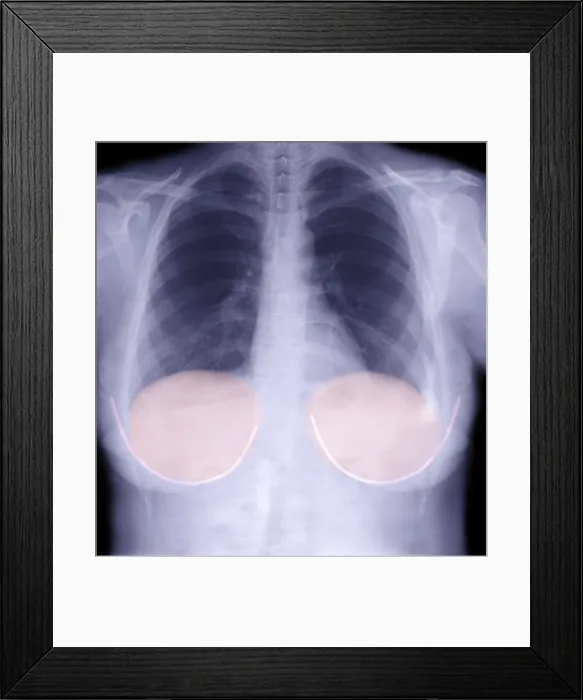Framed Print : Breast Implants