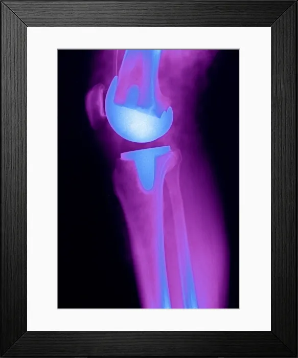 Framed Print : Knee Replacement X-ray Framed Print : Knee Replacement X-ray