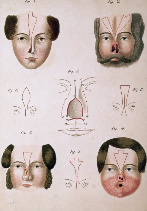 Framed Print : 19th Century Facial Reconstruction Framed Print : 19th Century Facial Reconstruction